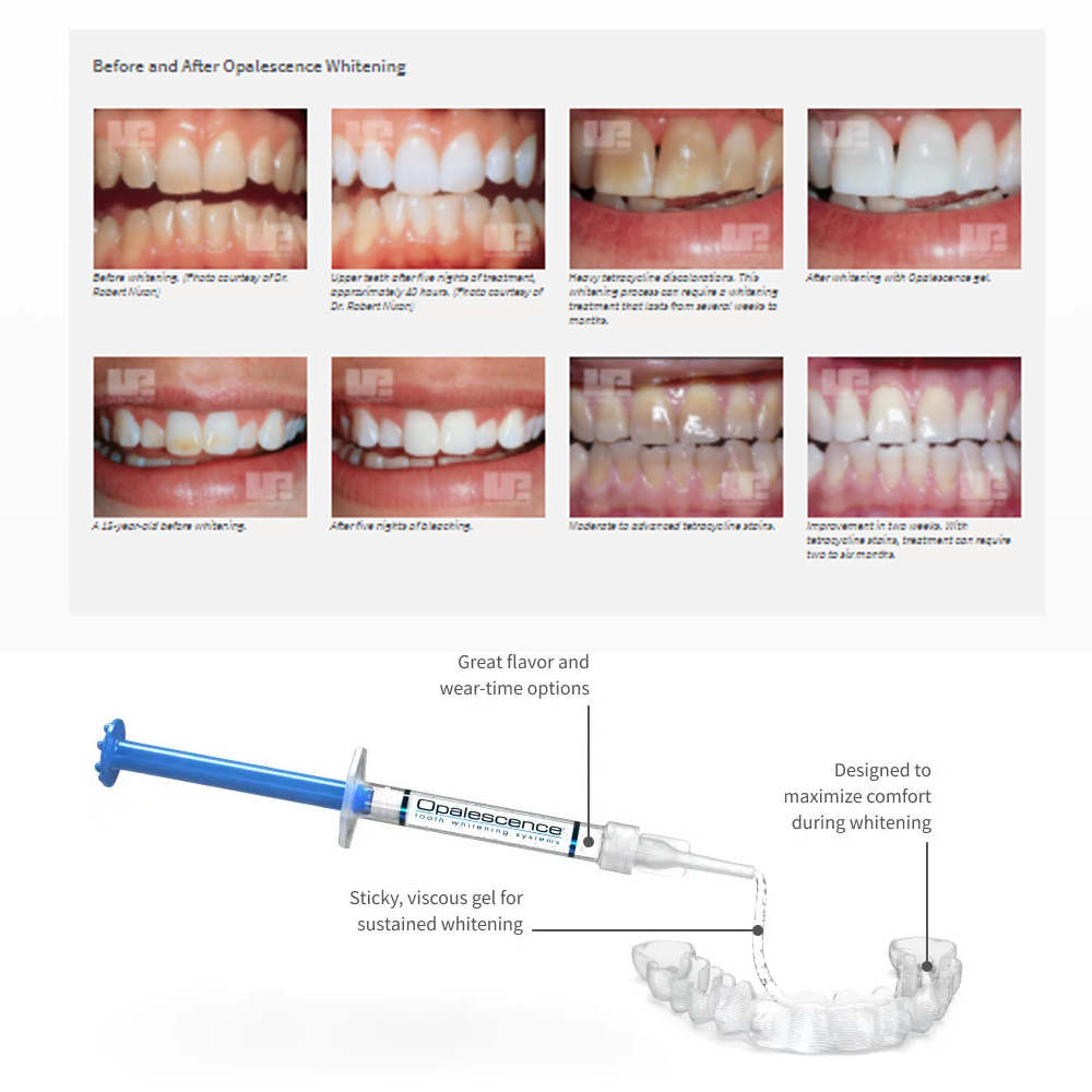 Opalescence Whitening 20% PF 2 - Teeth Whitening Flash 리뷰 및 가격