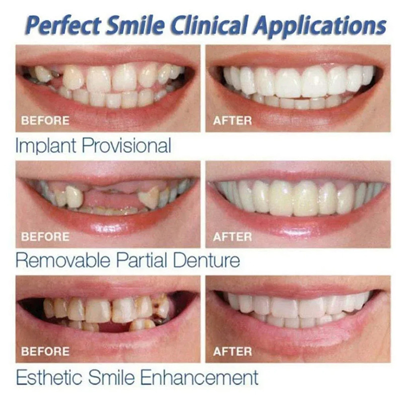 Veneer Snap-on Teeth Kit Fake  - Teeth Whitening Vape 리뷰 및 가격