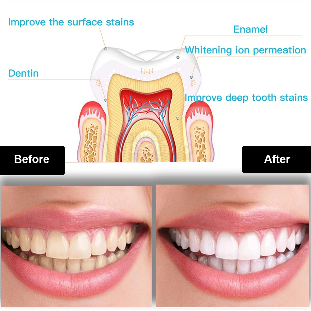 Dental Teeth Whitening Kit Min - Teeth Whitening Flash 리뷰 및 가격